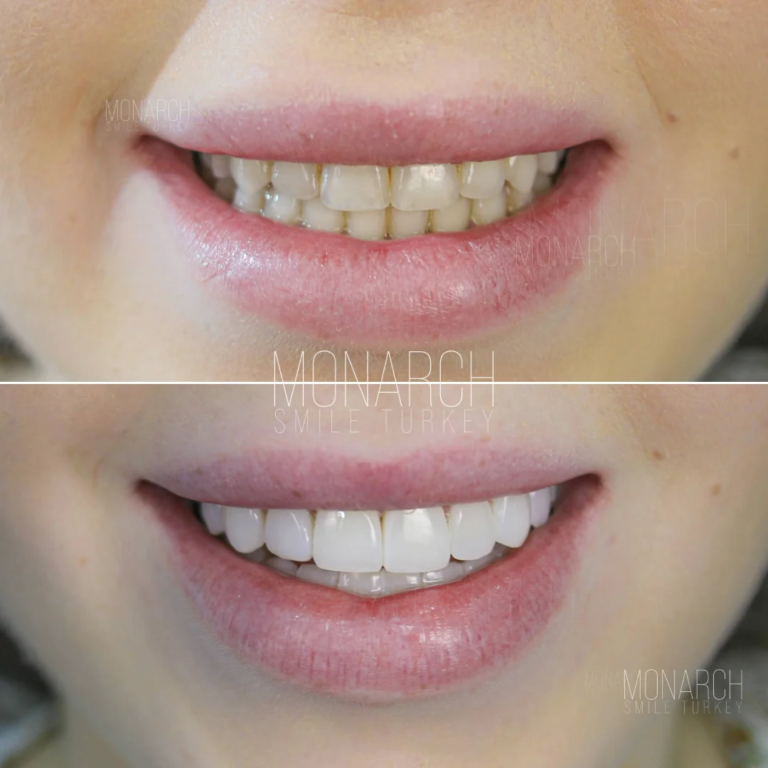 Before and after smile transformation — Monarch Smile Turkey