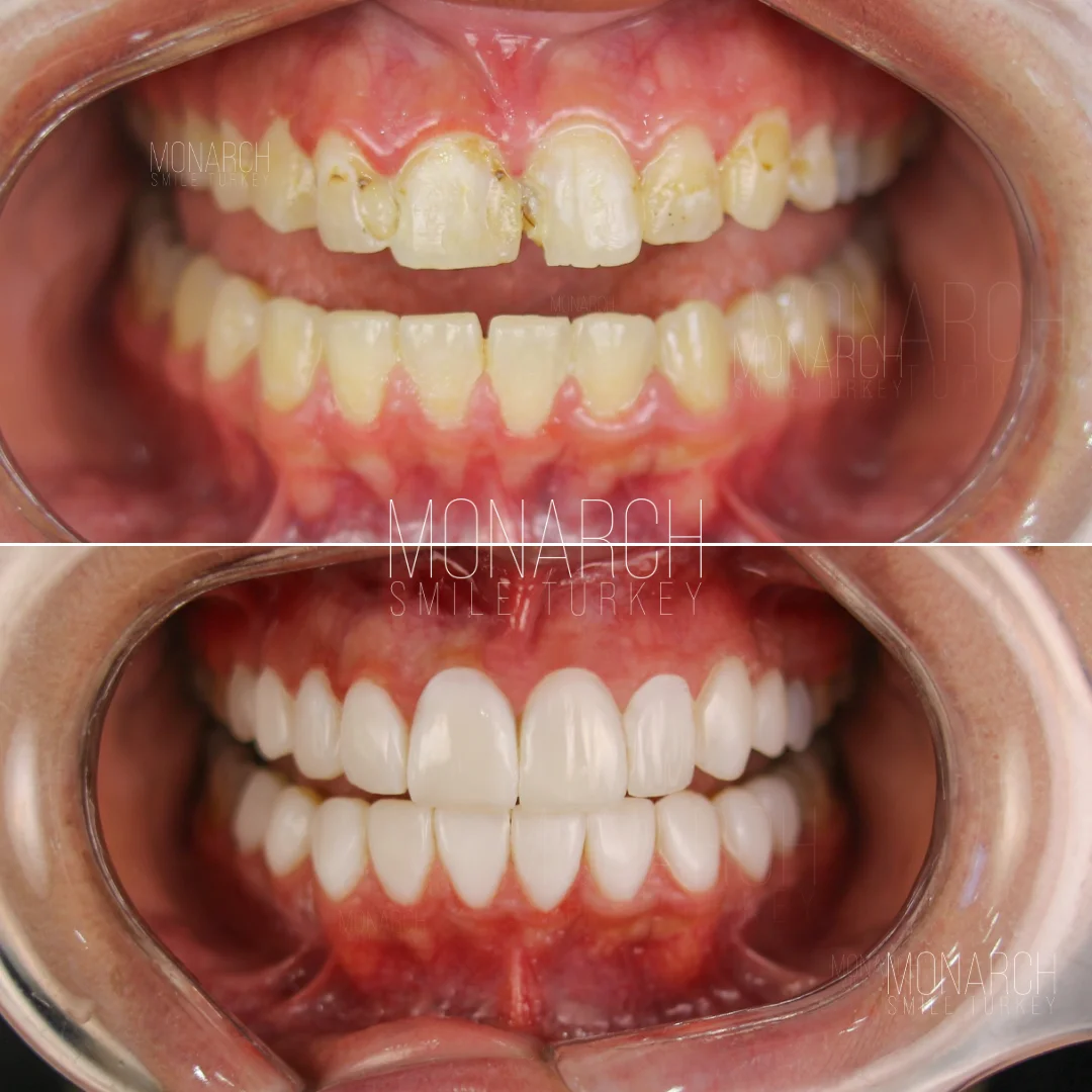 Before and after smile transformation — Monarch Smile Turkey