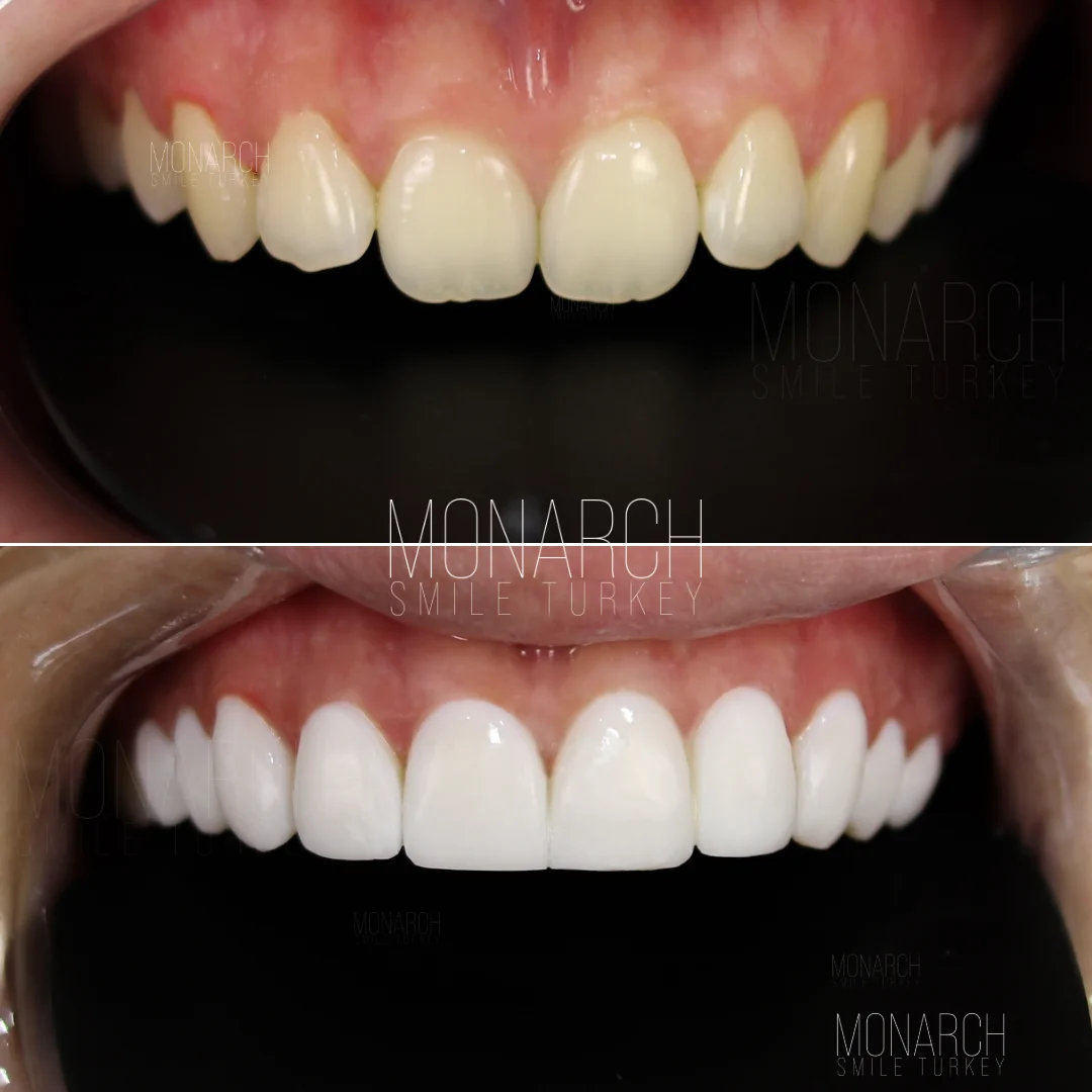 Before and after smile transformation — Monarch Smile Turkey