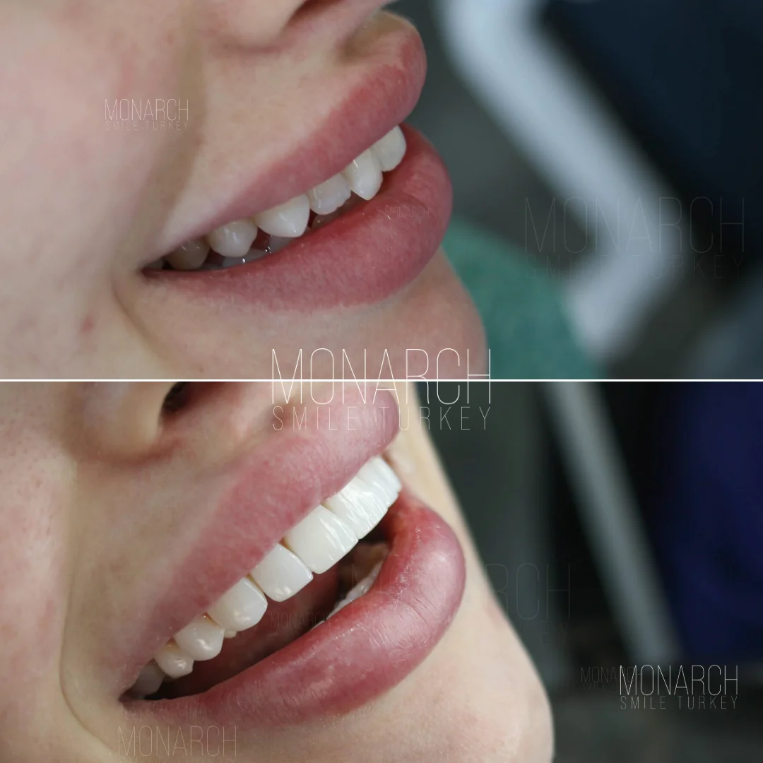 Before and after smile transformation — Monarch Smile Turkey