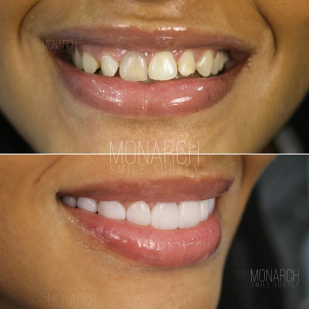 Before and after smile transformation — Monarch Smile Turkey