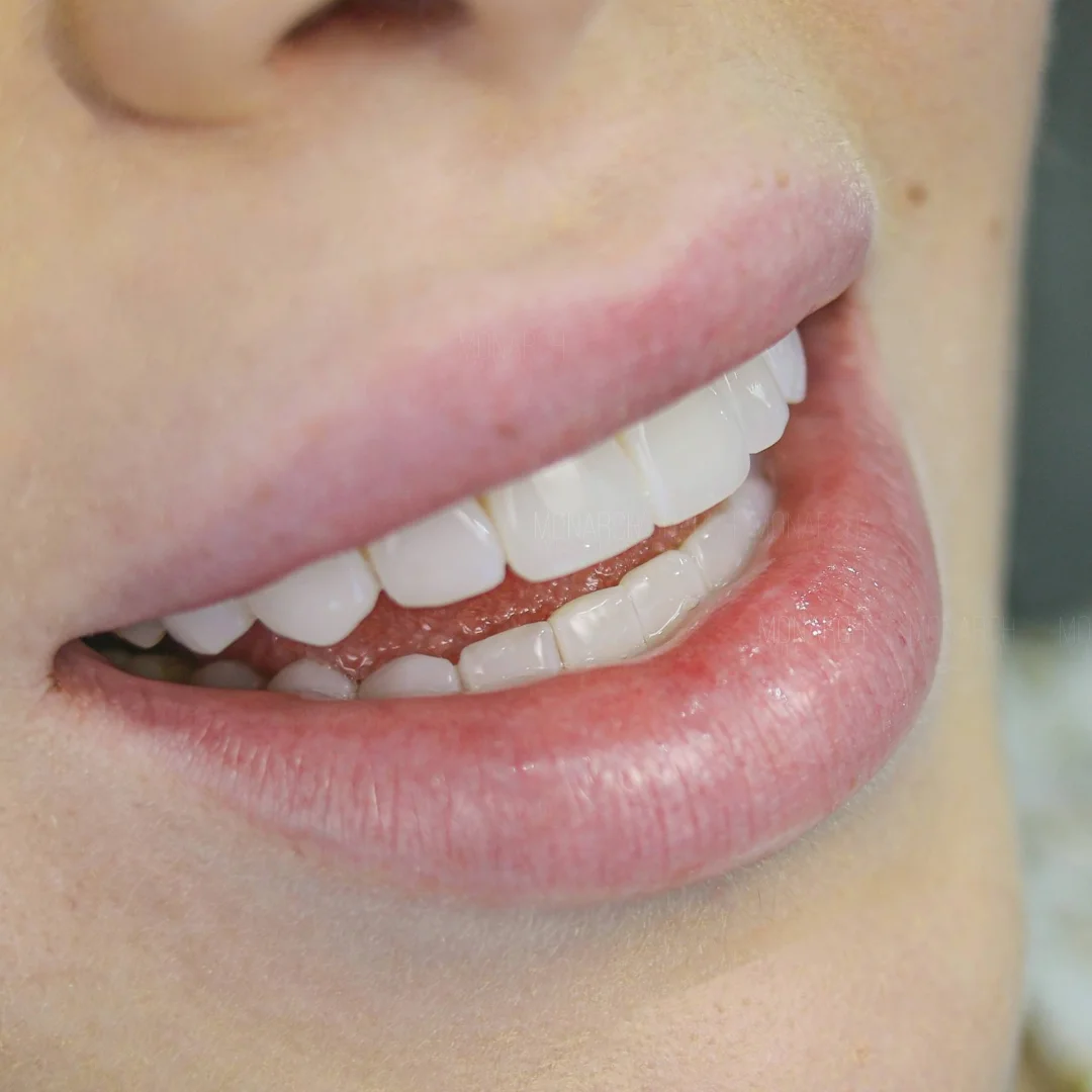 Before and after smile transformation — Monarch Smile Turkey