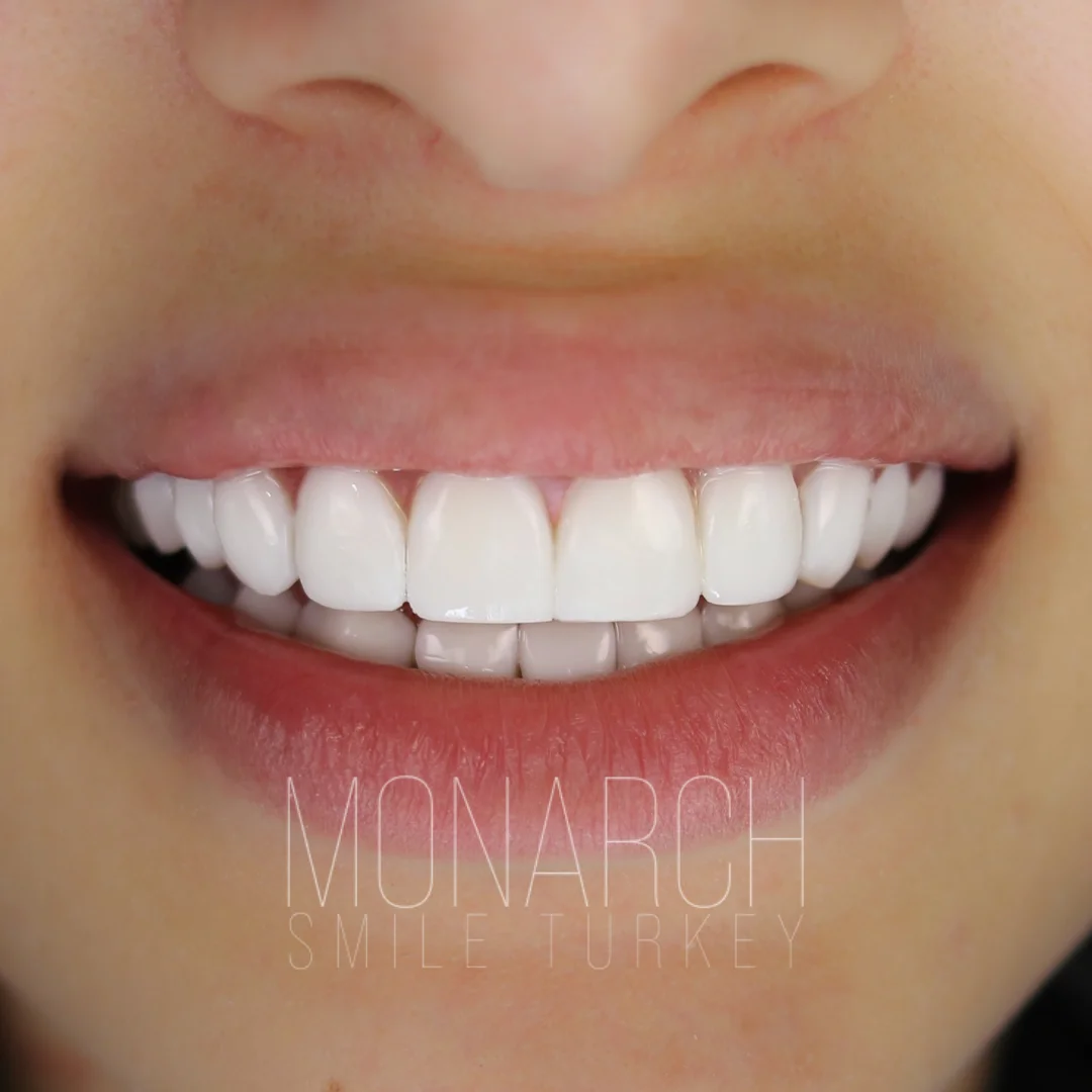 Before and after smile transformation — Monarch Smile Turkey
