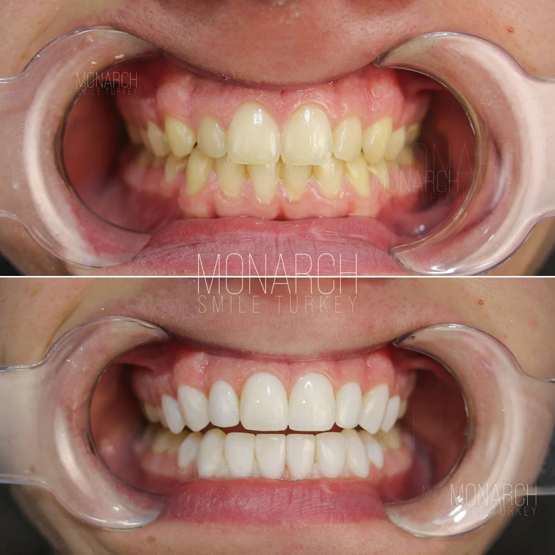 Before and after smile transformation — Monarch Smile Turkey