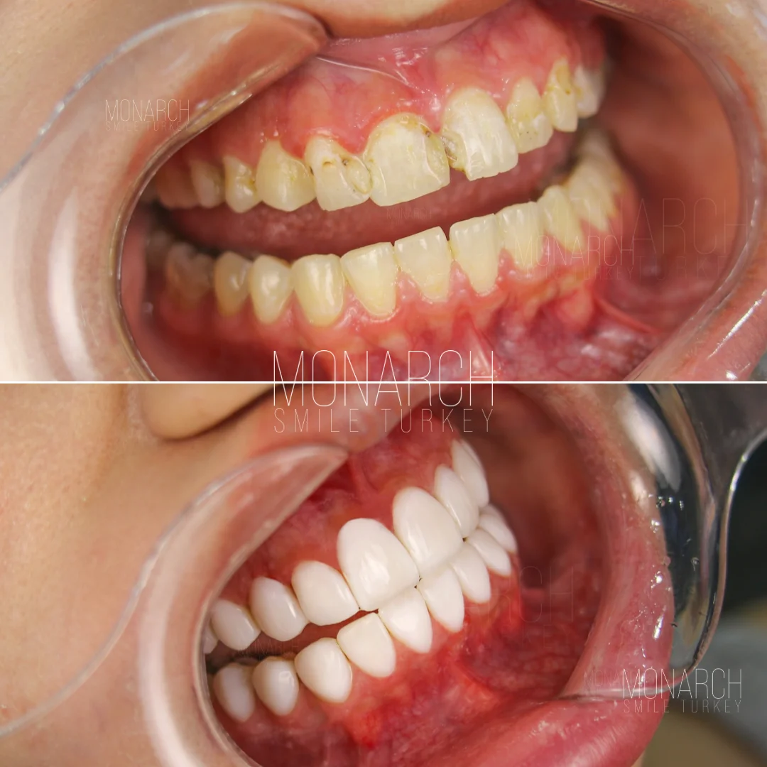 Before and after smile transformation — Monarch Smile Turkey