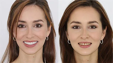 composite-bonding-veneers-turkey
