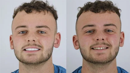 composite-bonding-veneers-turkey