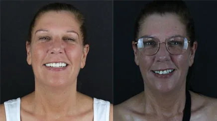composite-bonding-veneers-turkey