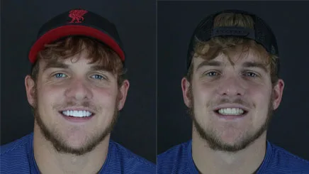 teeth-whitening