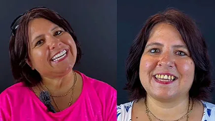 composite-bonding-veneers-turkey