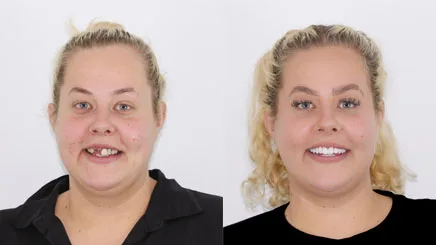 dental-implant