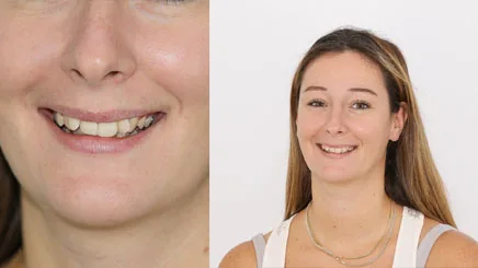 composite-bonding-veneers-turkey