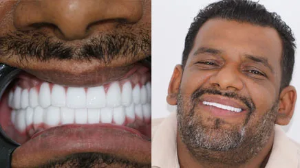 porcelain-veneers