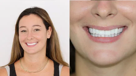 composite-bonding-veneers-turkey