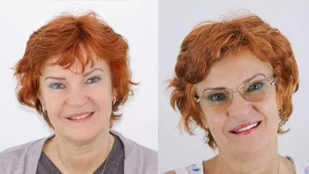 teeth-whitening