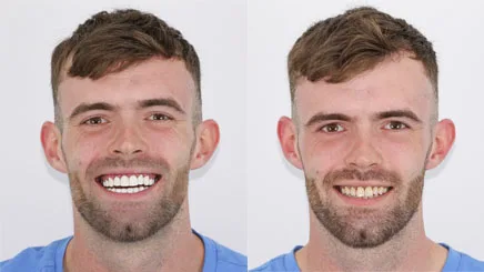 teeth-whitening