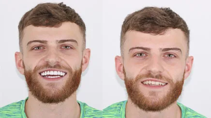 composite-bonding-veneers-turkey