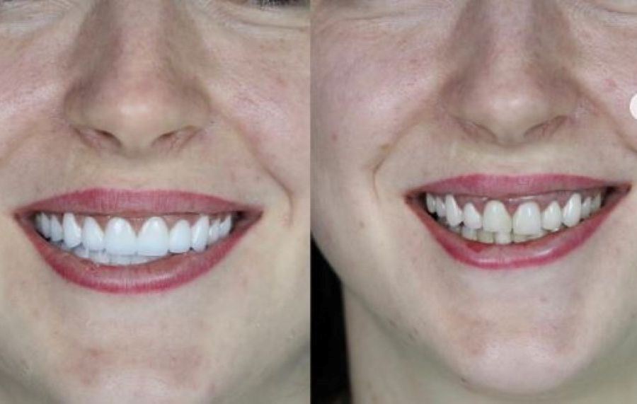 Is zirconium teeth procedure worth it? in Turkey