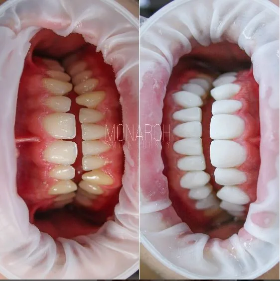 BLEACH WHITE Composite Veneers in turkey, antalya