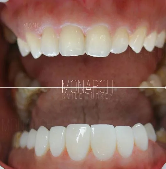 Composite-Bonding-Before-After in turkey, antalya