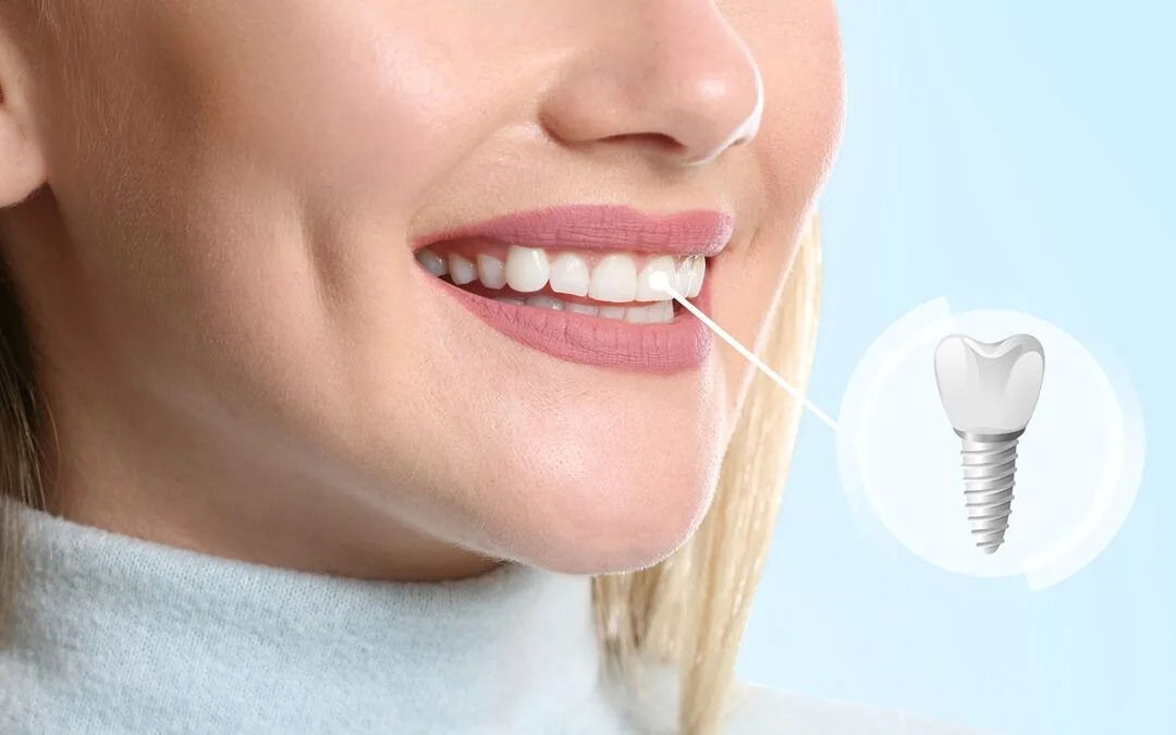 dental implant FAQs