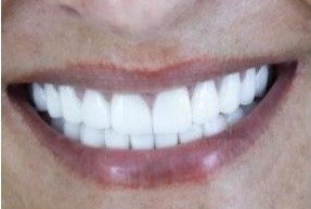 teeth-whitening in Antalya, Turkey