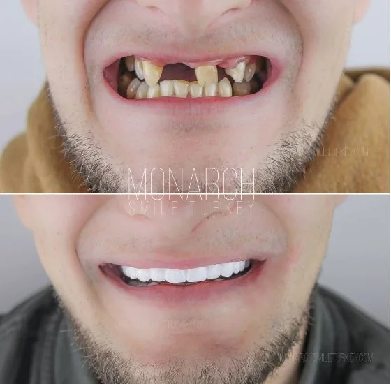 Does zirconium veneer and crown procedure hurt? in Turkey