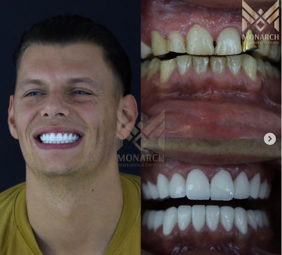Our patient from Netherlands Hollywood Smile with 28 Zirconium Crowns