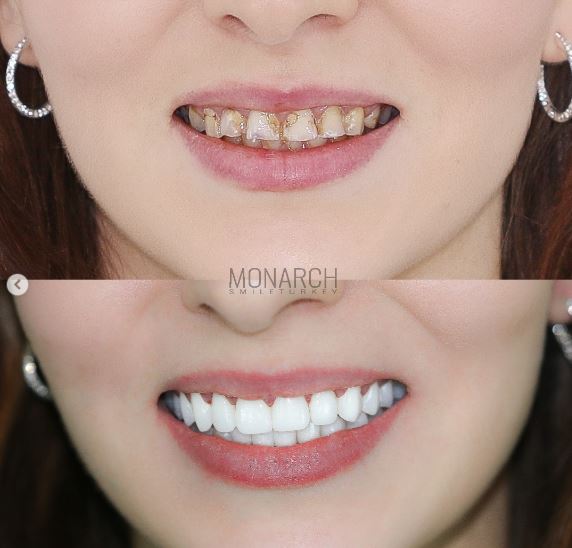 Hollywood smile with Zirconium Crowns in Turkey