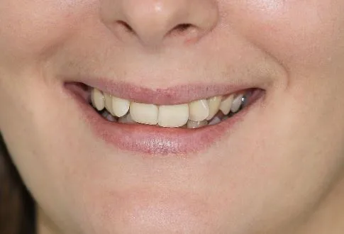 zirconium-crowns before