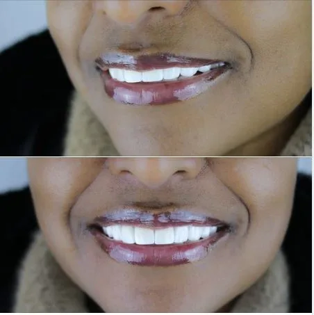 Full set of zirconia crowns-Color: OM3 antalya