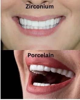Zirconium-Crowns-Veneers Antalya turkey