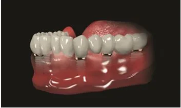 All On 6 Dental Implant in Turkey
