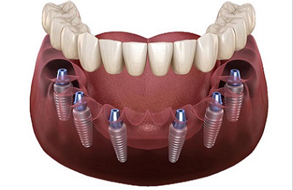 All On 6 Dental Implant in Turkey