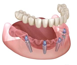 Is it safe to get all on four teeth implants in Turkey? 