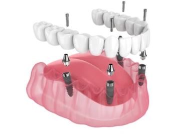 Can I get all on 4 dental implants years after tooth extraction?