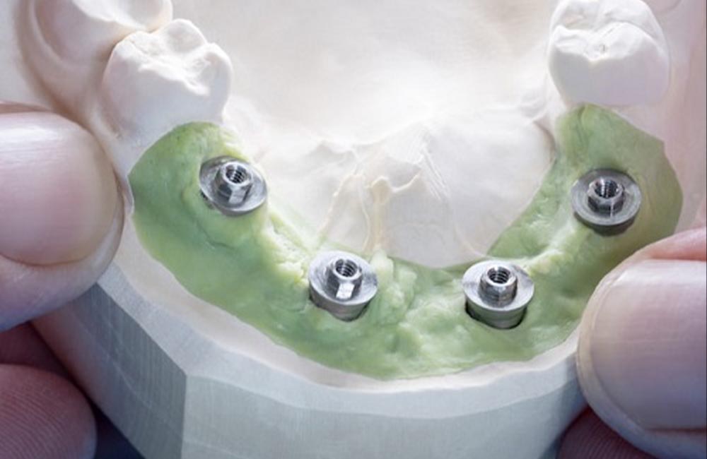  What is all on four dental implant treatment? in Turkey, Antalya