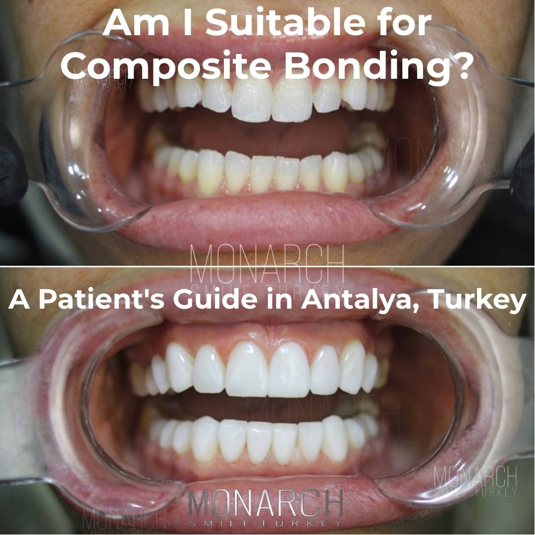Am I Suitable for Composite Bonding?