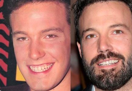 celebrities-with-veneers-ben-affleck celebrities-with-veneers-ben-affleck