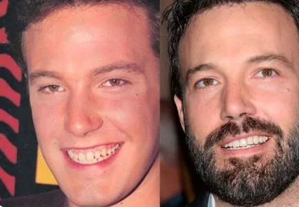 celebrities-with-veneers-ben-affleck celebrities-with-veneers-ben-affleck