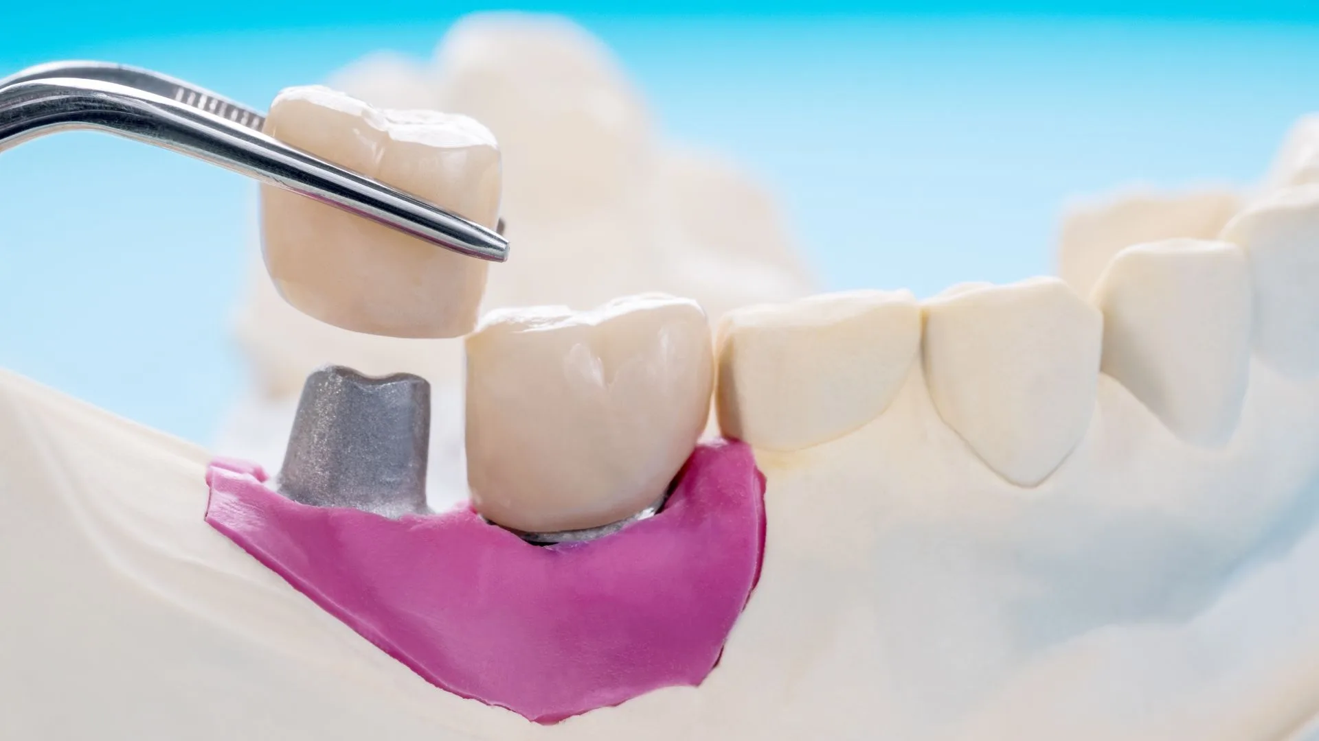 bonding-implant-antalya
