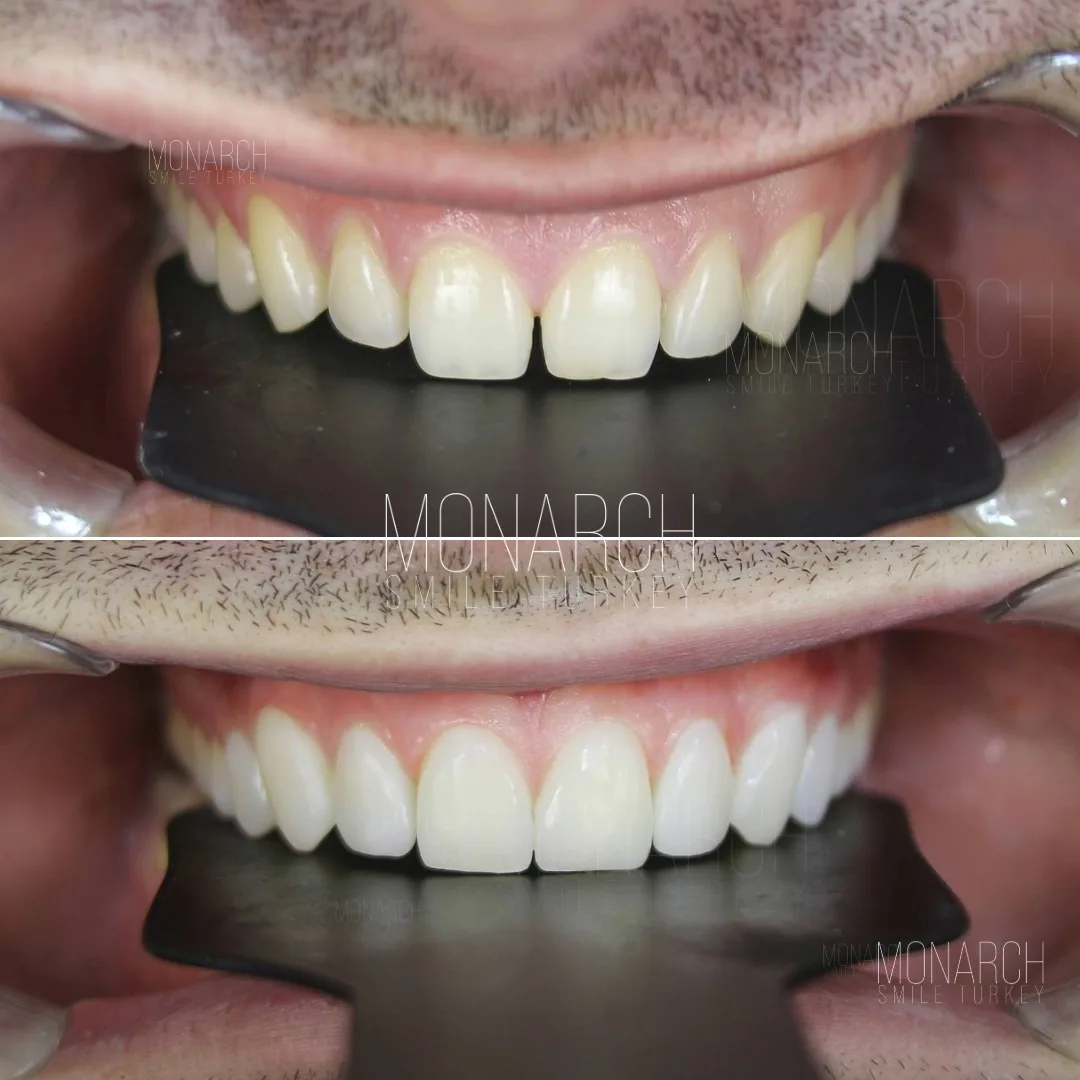 Composite bonding in turkey, antalya