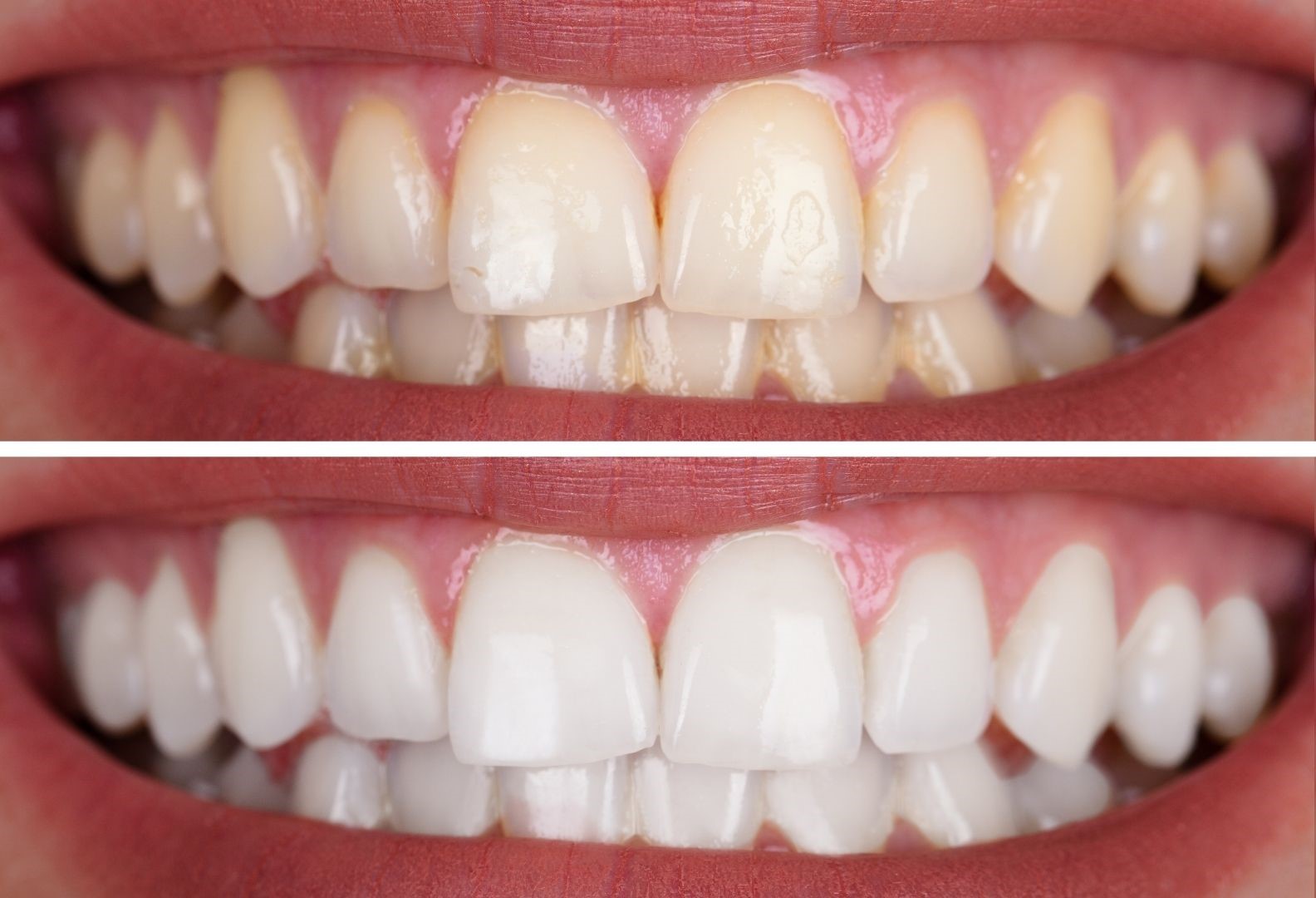 Teeth Whitening (Bleaching) in turkey, antalya