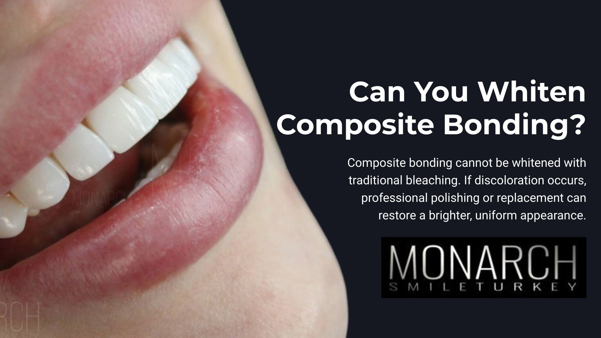 Can You Whiten Composite Bonding?