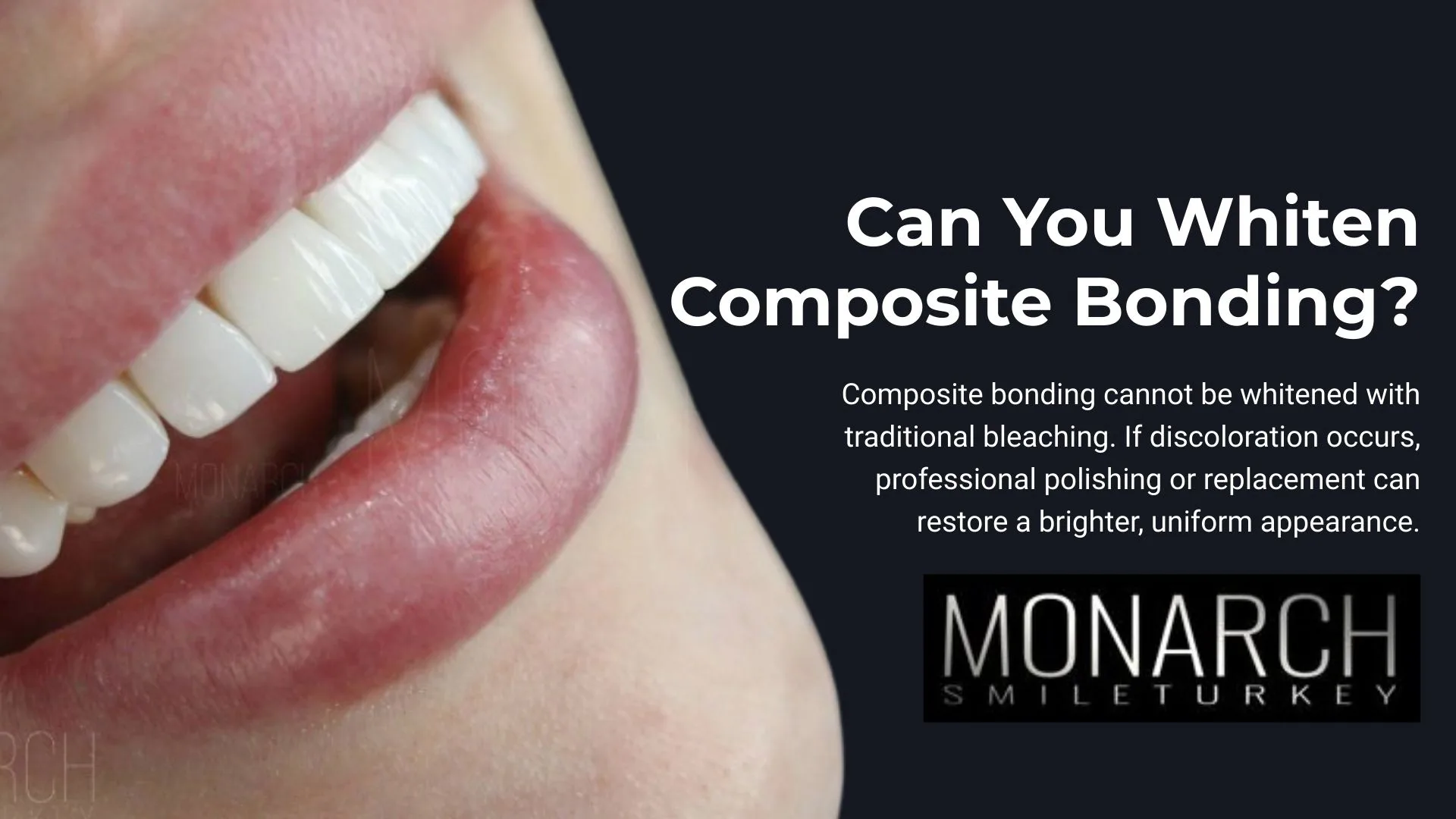 can-you-whiten-composite-bonding?