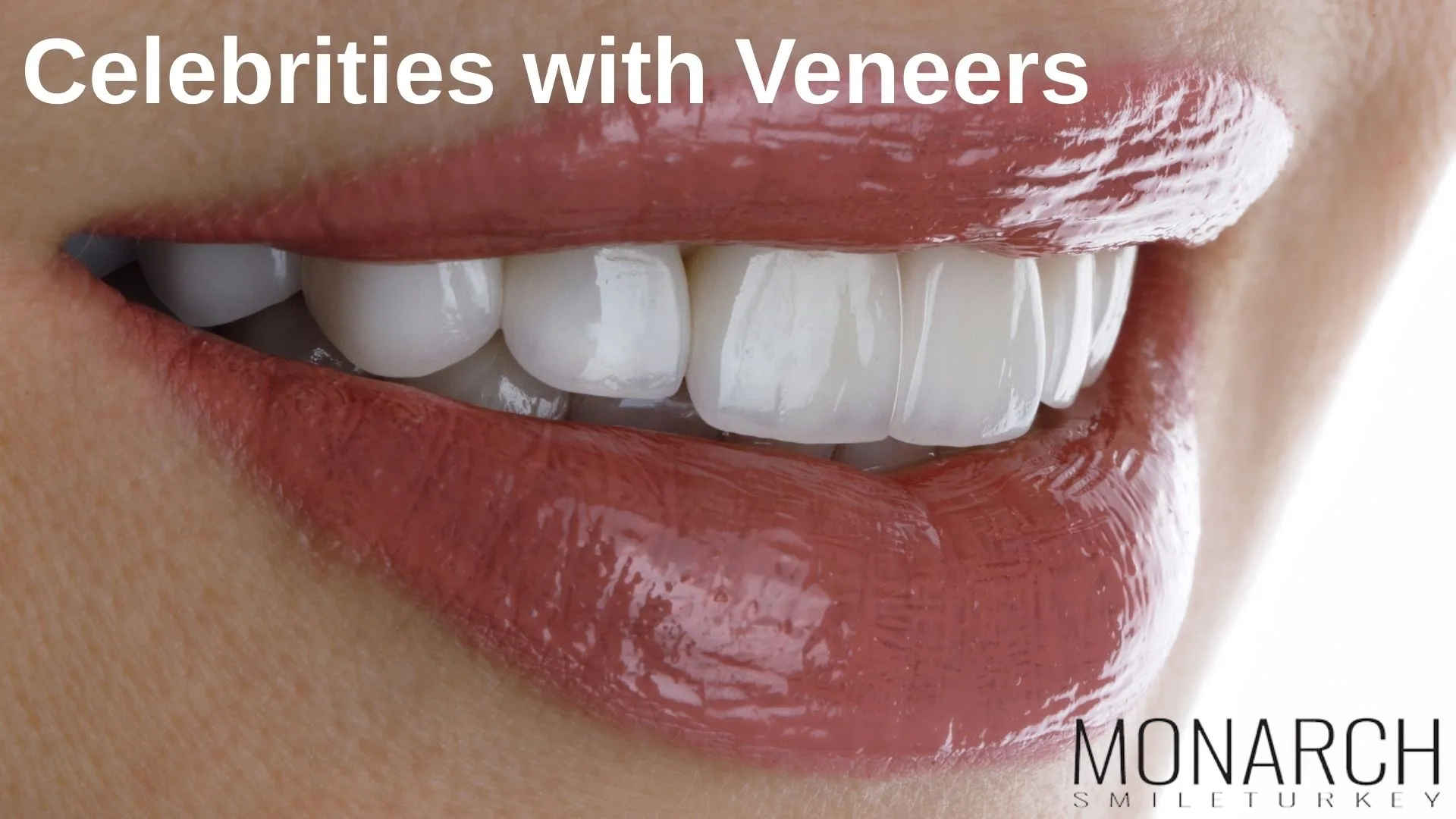 celebrities-with-dental-veneers