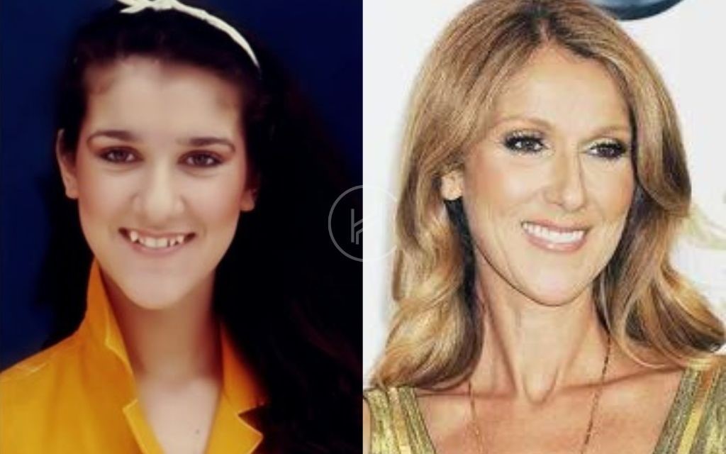 celebrities-with-veneers-Celine Dion celebrities-with-veneers-Celine Dion