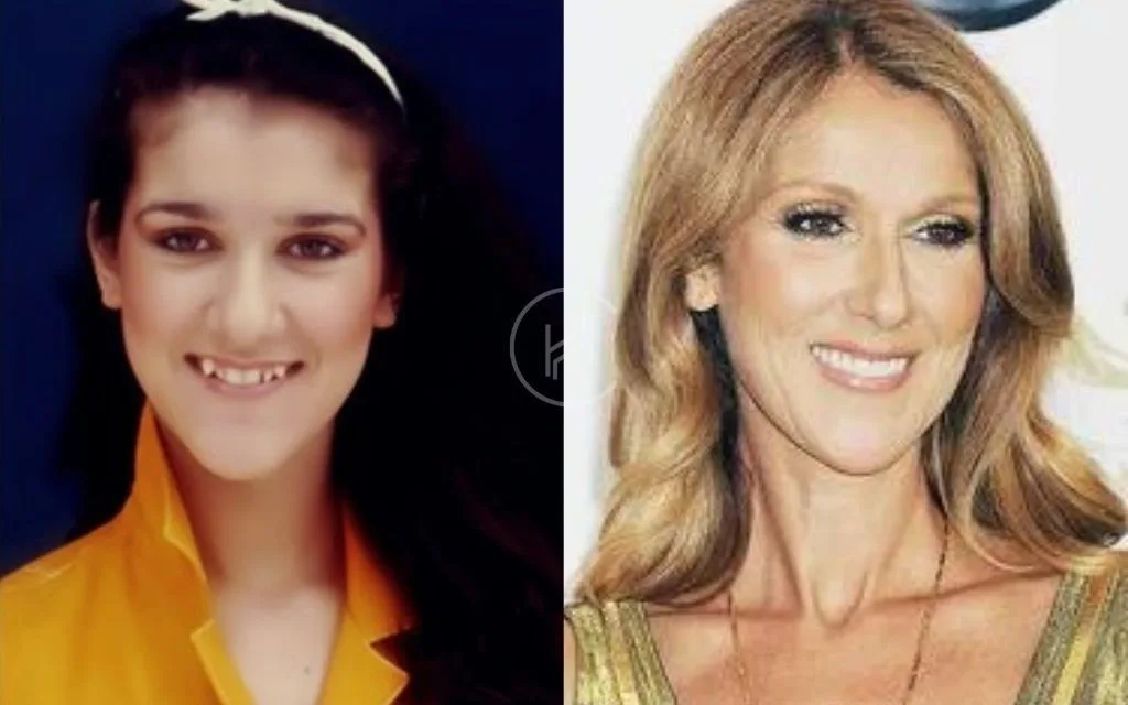 celebrities-with-veneers-Celine Dion celebrities-with-veneers-Celine Dion