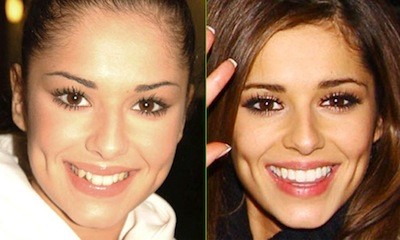 celebrities-with-veneers-Cheryl Cole celebrities-with-veneers-Cheryl Cole