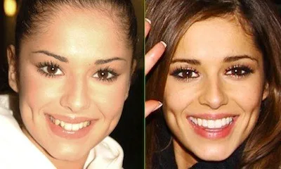 celebrities-with-veneers-Cheryl Cole celebrities-with-veneers-Cheryl Cole